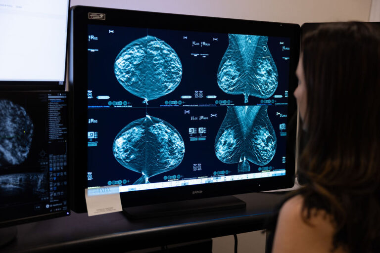 Dr White is viewing digital mammogram images of breasts displayed on a large computer monitor in a medical setting.
